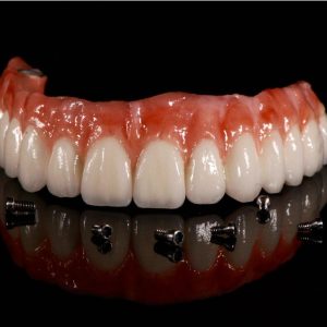 Implantology ALL ON 4