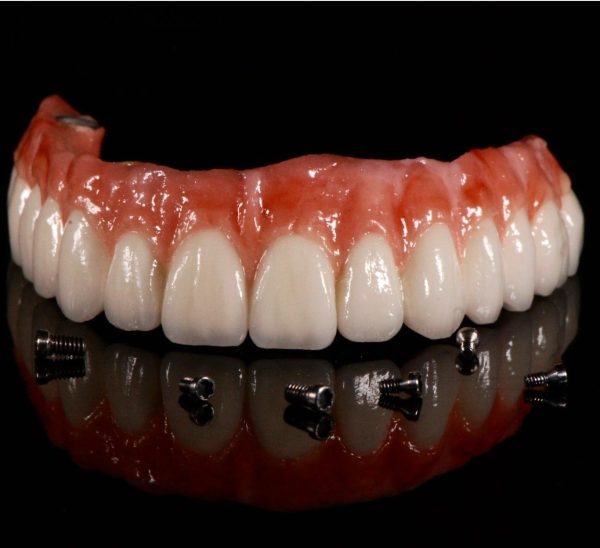 Implantology ALL ON 6